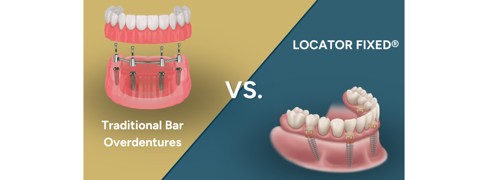 Graphic comparing digital models of traditional bar overdentures versus LOCATOR FIXED overdentures