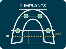 4 implant diagram