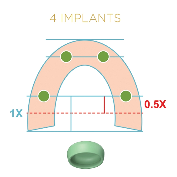 4 Implants LOCATOR FIXED Green Inserts