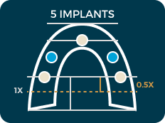 5 implant diagram