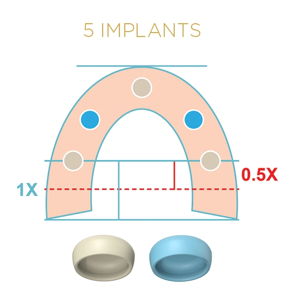 5 Implants LOCATOR FIXED Blue and Tan Inserts