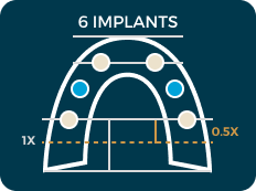 6 implant diagram