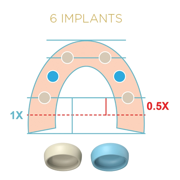 6 Implants LOCATOR FIXED Blue and Tan Inserts