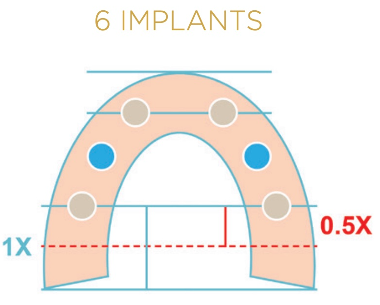 Blue and Tan LOCATOR FIXED Inserts on a 6 Implant Case