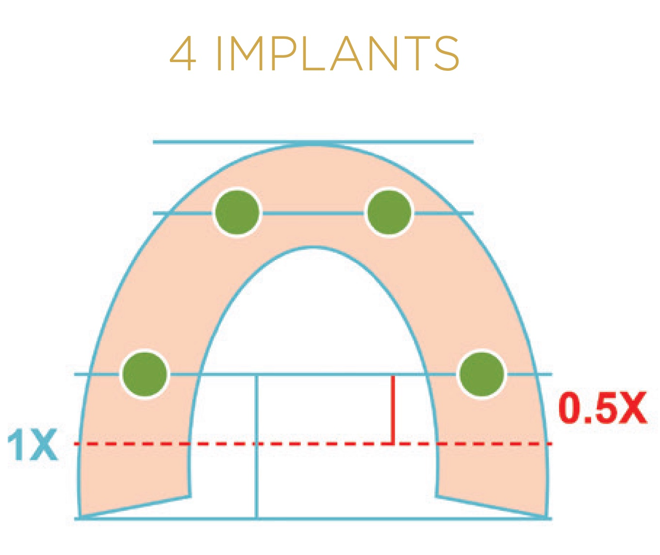 How do LOCATOR FIXED Green Inserts Work