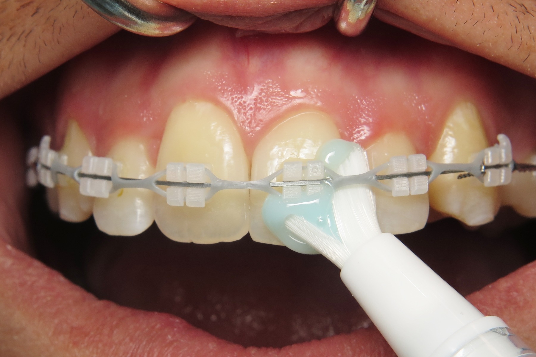 Regal GO Braces Orthodontia Toothbrush Toothpaste Combo Pen