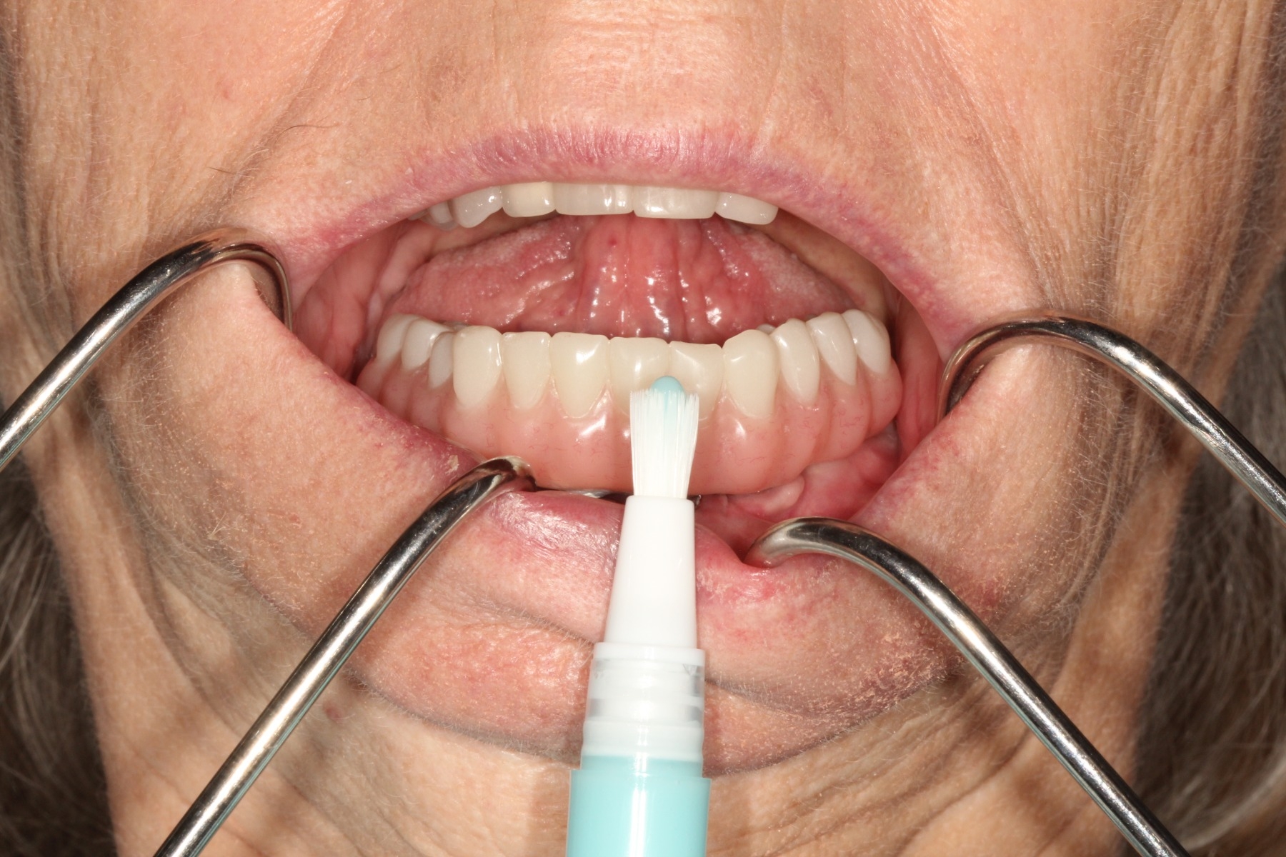 Regal GO Implant All on 4 Permanent Overdenture Toothbrush Toothpaste Combo Pen