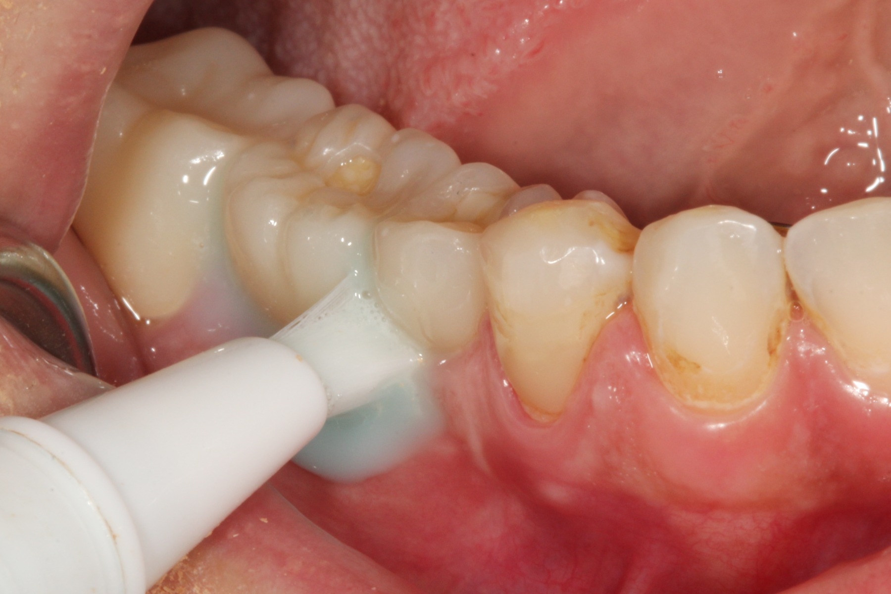 Regal GO Toothbrush Toothpaste Combo Pen for Crowns and Bridges