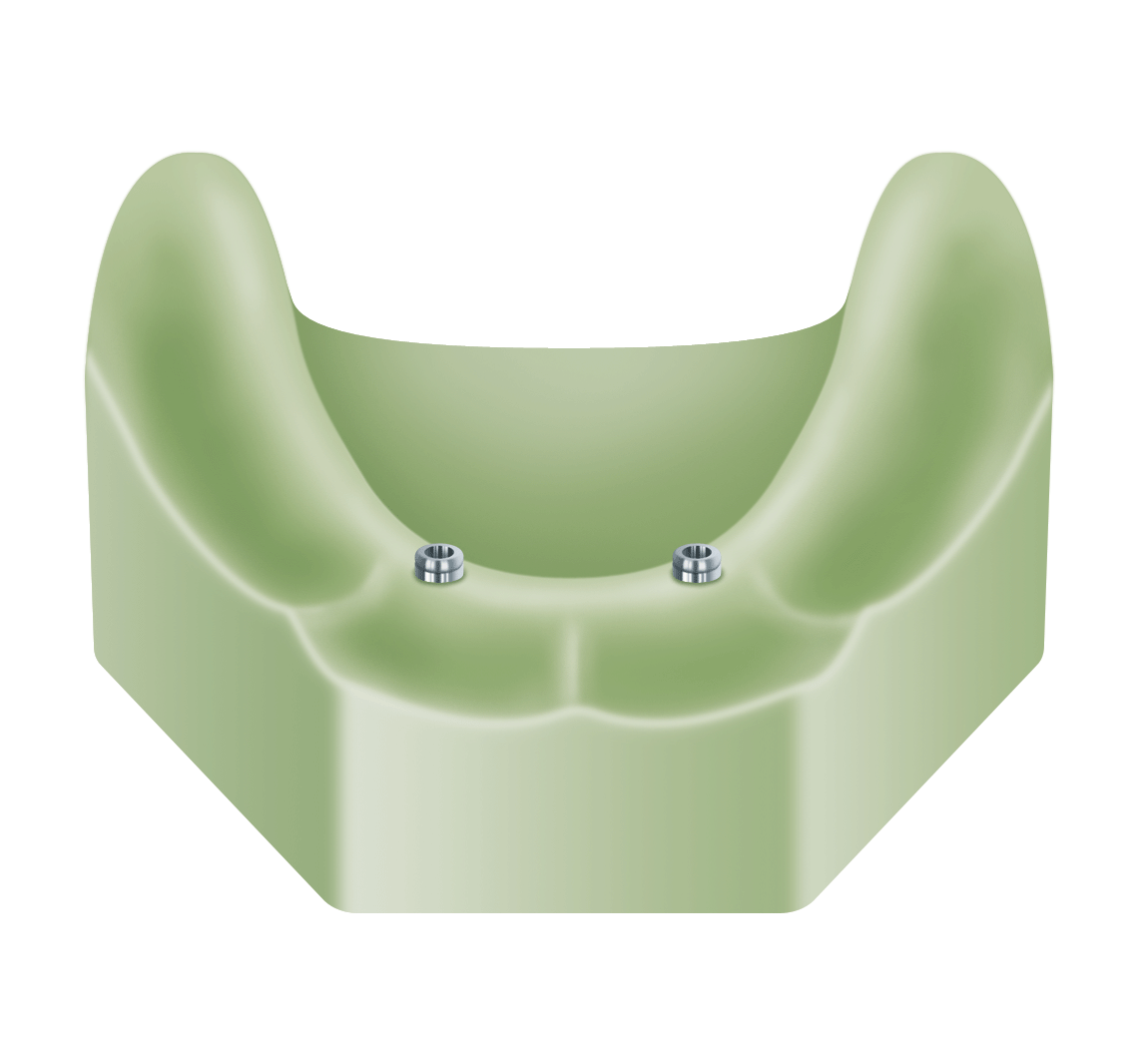 LOCATOR analogs in stone model