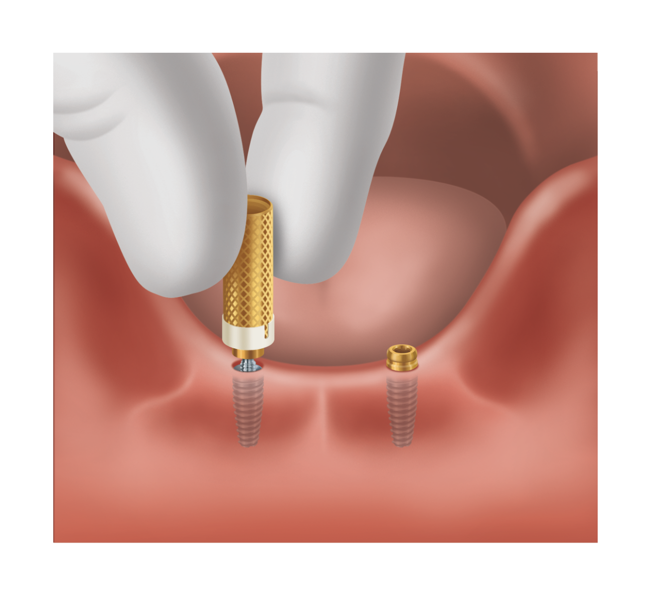 Placing LOCATOR abutment